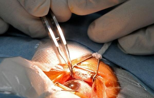 phẩu thuật đục thủy tinh thể là cách điều trị duy nhất hiện nay